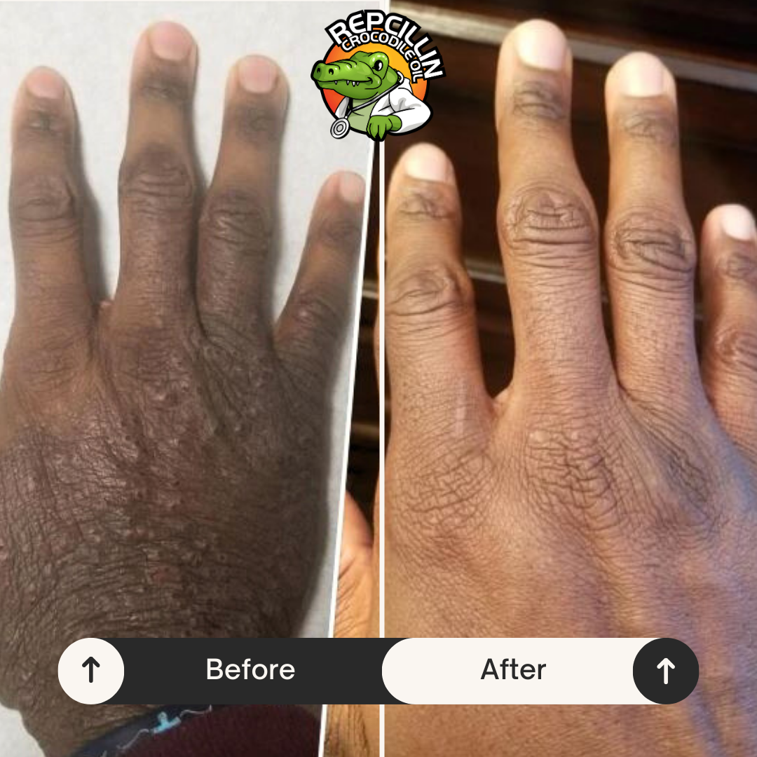 Amazing Eczema Treatment with Repcillin Natural Products