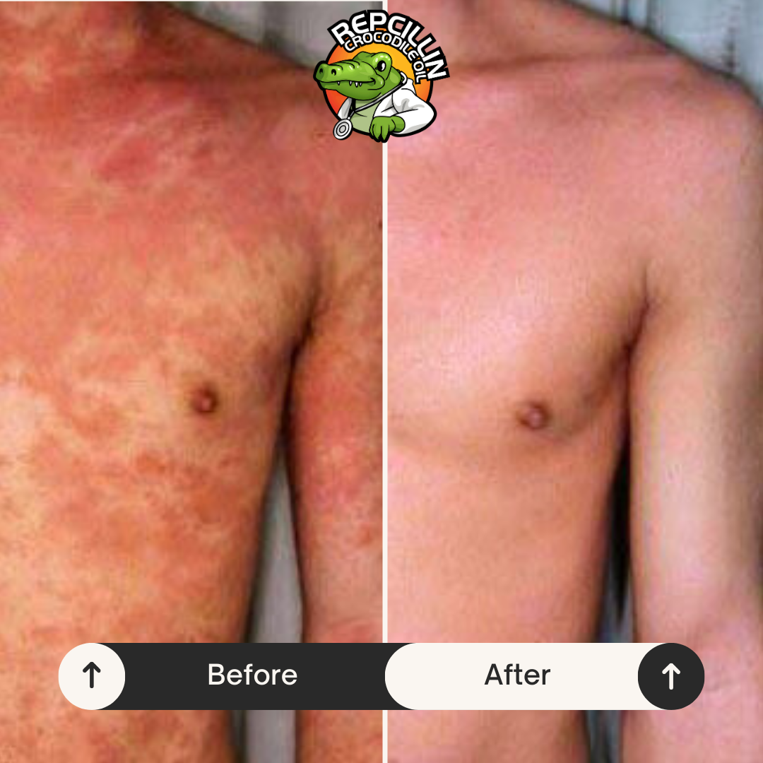 Amazing Eczema Treatment with Repcillin Natural Products